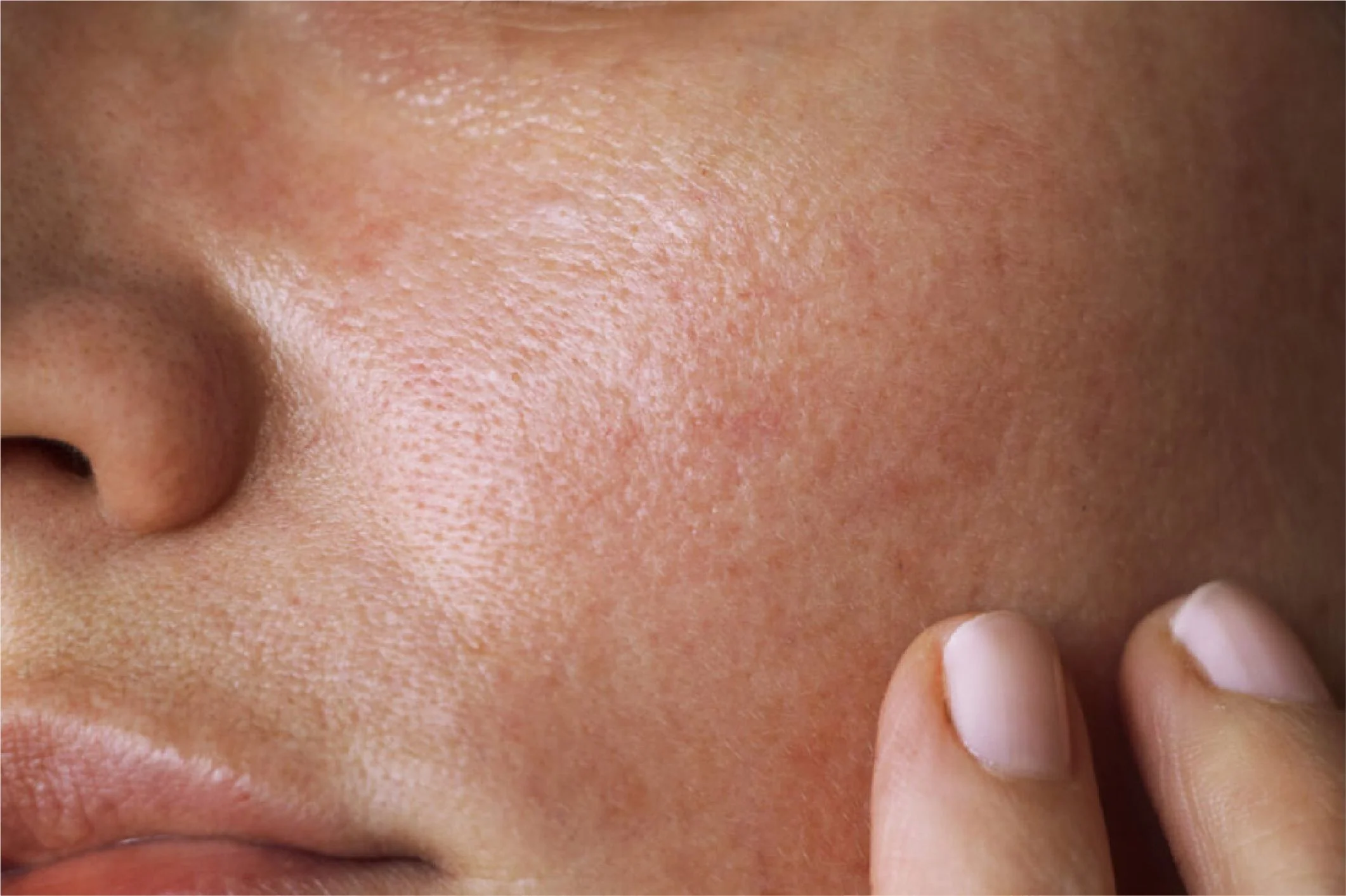 Oily but Dehydrated Skin: 7 Signs, Causes, and the Best Routine — Skin guide by It Girlies