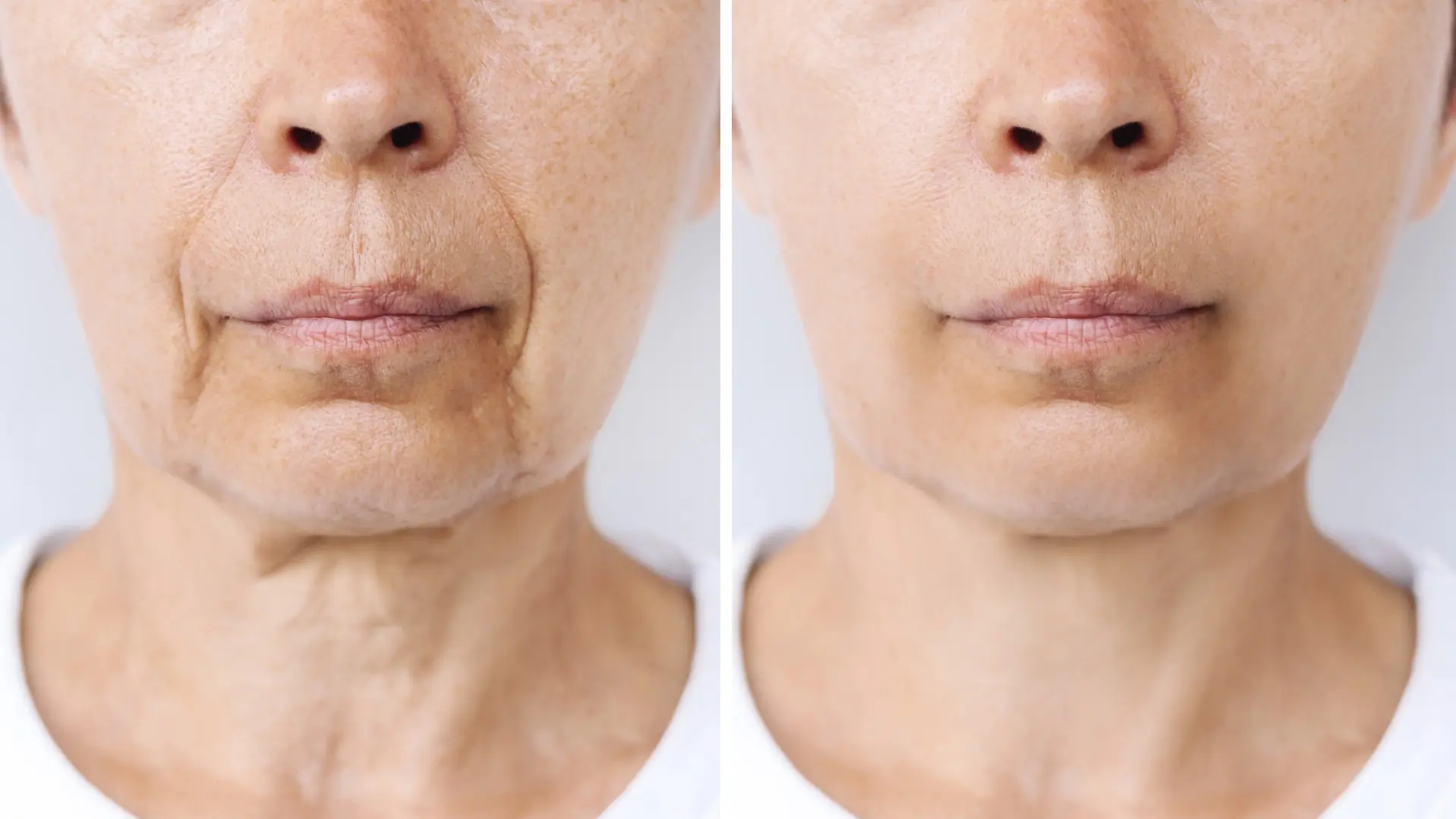 Is Ozempic Face Permanent? What Dermatologists Actually Say — Skin guide by It Girlies